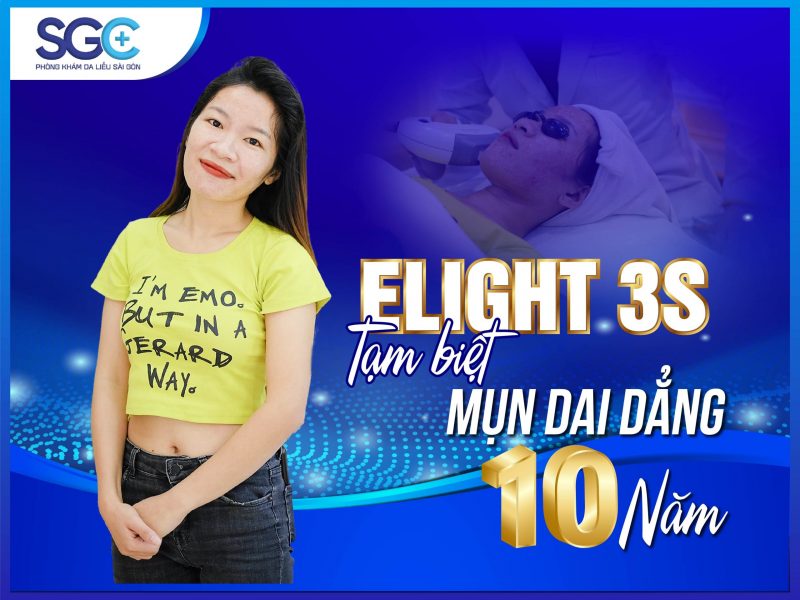 DỨT ĐIỂM MỤN DAI DẲNG 10 NĂM CỦA KHÁCH HÀNG KIM HOÀNG