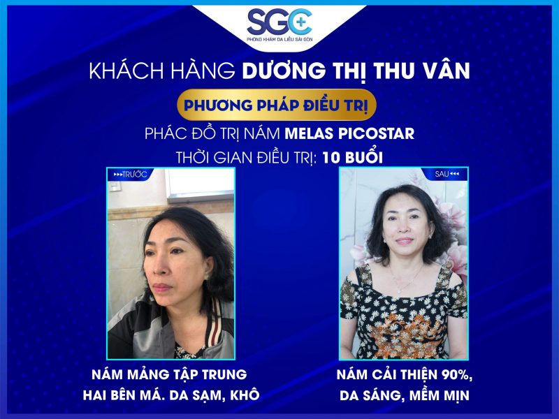 SẠCH NÁM SÁNG DA CHỈ SAU 1 LIỆU TRÌNH CỦA CHỊ DƯƠNG THỊ THU VÂN