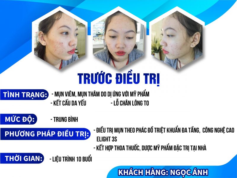 ĐIỀU TRỊ MỤN THÀNH CÔNG DO SỬ DỤNG MỸ PHẨM KHÔNG RÕ NGUỒN GỐC CỦA KHÁCH HÀNG NGỌC ÁNH