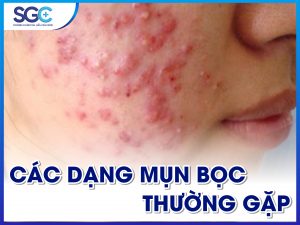 CÁC DẠNG MỤN BỌC THƯỜNG GẶP