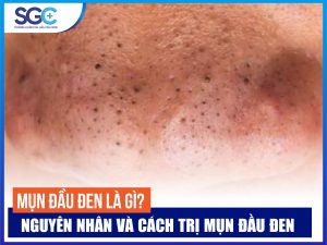 MỤN ĐẦU ĐEN LÀ GÌ? NGUYÊN NHÂN VÀ CÁCH TRỊ MỤN ĐẦU ĐEN