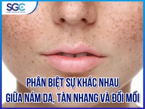 PHÂN BIỆT SỰ KHÁC NHAU GIỮA NÁM DA, TÀN NHANG VÀ ĐỒI MỒI