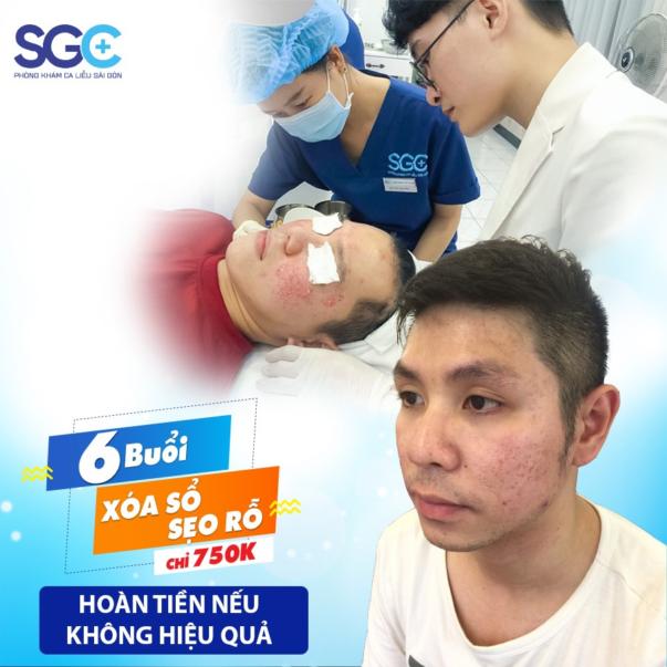 TRỊ SẸO RỖ – LÕM BẰNG CÔNG NGHỆ MESO SCAR 9 IN 1 TẠI PHÒNG KHÁM DA LIỄU SÀI GÒN